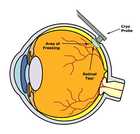 Cryopexy — THE RETINA INSTITUTE