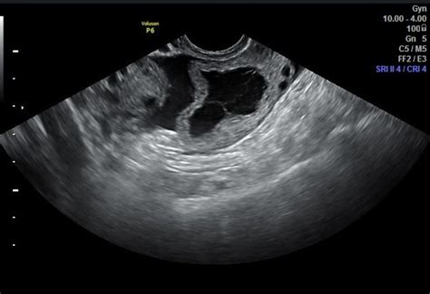 Ruptured Ovarian Cyst
