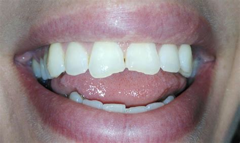 Dentist In Aurora IL Composite Resin For Chipped Tooth