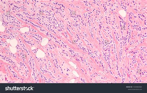 Invasive Lobular Carcinoma: Over 45 Royalty-Free Licensable Stock ...