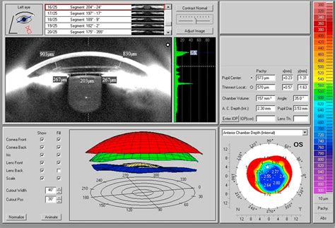 Figure 1 From Iris Fixated Phakic Intraocular Lens Implantation For