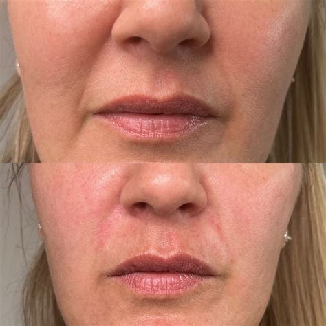 Nasolabial Fold Filler Smile Lines The Face Clinic By Stevie Marie