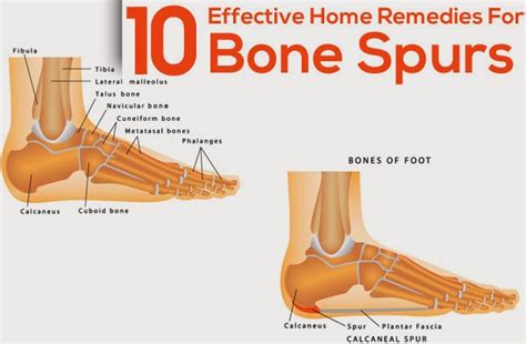 10 Effective Home Remedies For Bone Spurs ~ Mzizi Mkavu