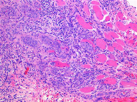 Oral Squamous Cell Carcinoma Histology