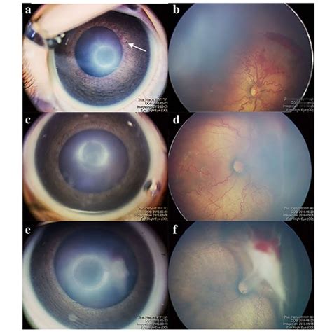 Fundus photographs of a patient in the retinal detachment group. a An ...