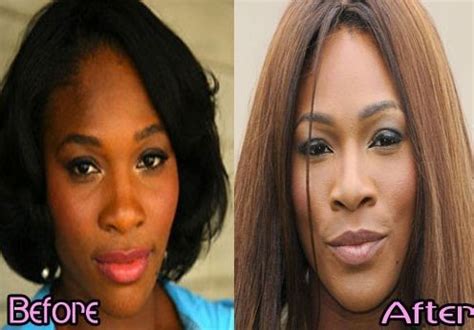 Serena Williams before and after plastic surgery 06 – Celebrity plastic ...