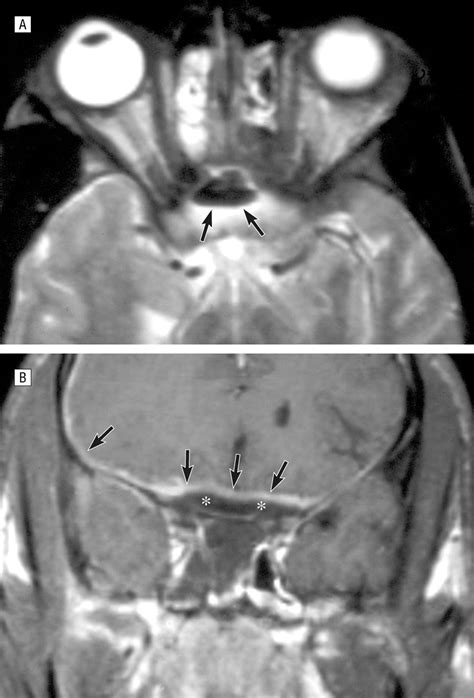 Evaluation And Surgical Management Of Isolated Sphenoid Sinus Disease