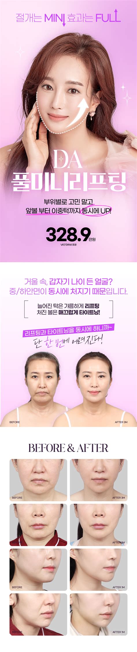 디에이 풀미니리프팅 By 디에이성형외과의원 강남언니 1등 성형수술and피부시술 정보앱