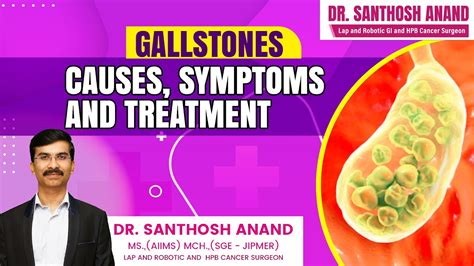 Gallstones Causes Symptoms And Treatment Dr Santhoshanand Youtube