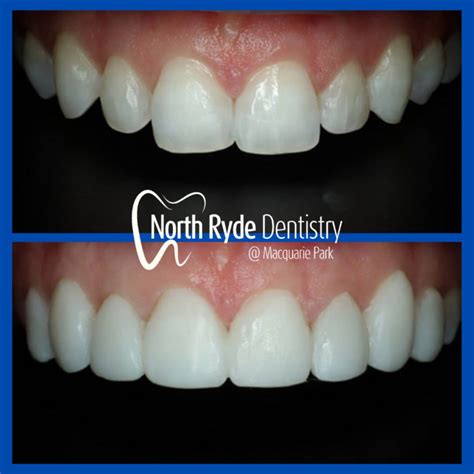 Macquarie Park Crowns And Veneers Package Dentists In North Ryde