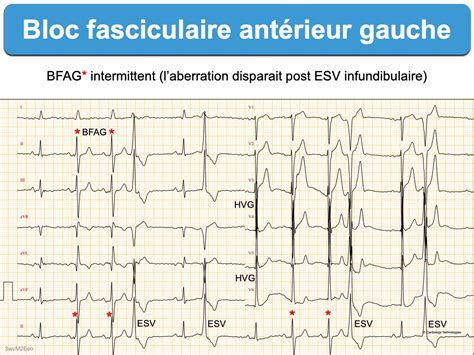 Bloc Fasciculaire Ant Rieur Gauche E Cardiogram