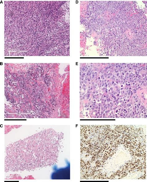 Refractory Alveolar Rhabdomyosarcoma In An Year Old Male