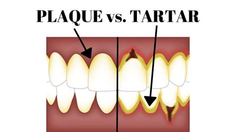 How To Remove PLAQUE vs.TARTAR