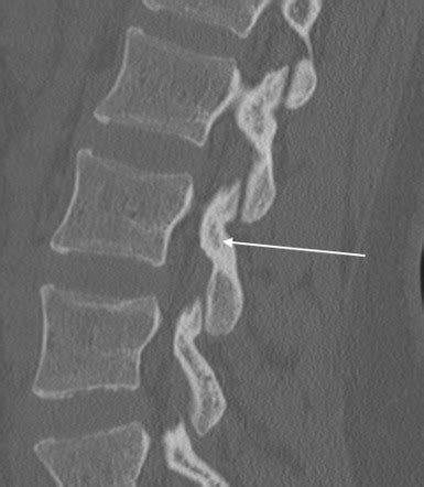 Pars interarticularis | Radiology Case | Radiopaedia.org