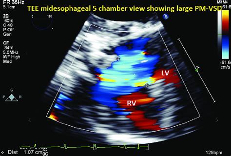 TEE CFD In Midesophageal 5 Chamber View Showing Large Perimembranous