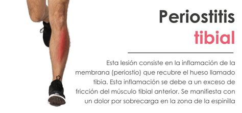 Periostitis Tibial