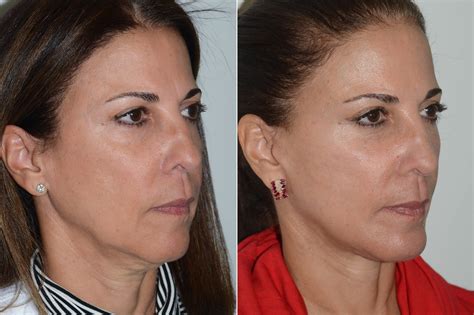 Implante De Ment N Lifting Facial Facelift Fotos Coral Gables Fl