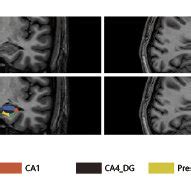 Hippocampal Subfield Segmentation Coronal And Sagittal Views Of The