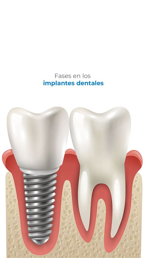 Fases En Los Implantes Dentales CCM Dental