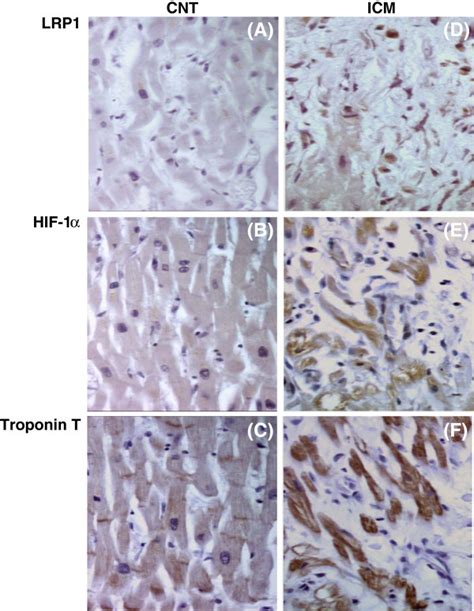 LRP1 HIF 1α and troponin T staining in control and ICM hearts