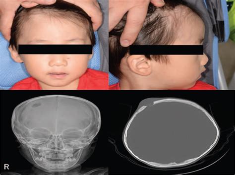 Split Calvarial Bone Graft For Reconstruction Of Skull Defec