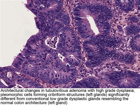 Pathology Outlines - Tubulovillous / villous adenoma