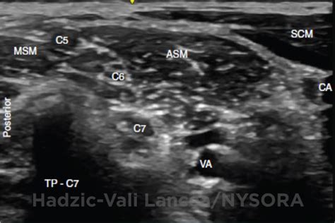 Ultrasoundguided Infraclavicular Brachial Plexus Block