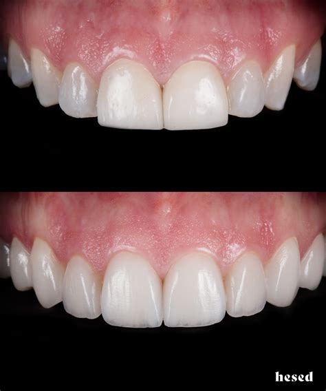 Veneers vs Dentures: Which One to Choose and Why?