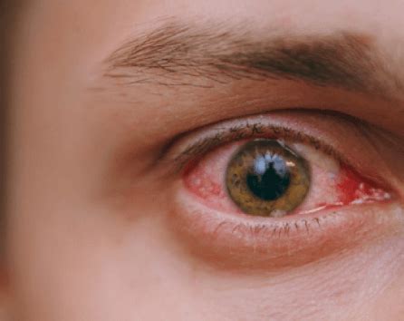 Descubre Todo Sobre La Carnosidad En Los Ojos Causas Sintomas Y