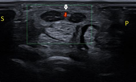 Bifid Median Nerve With Persistent Median Artery In Carpal Tunnel