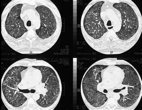 Pneumocystis Carinii Pneumonia High Resolution Computed Tomography Download Scientific Diagram