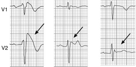 Arrhythmia Management Flashcards Quizlet