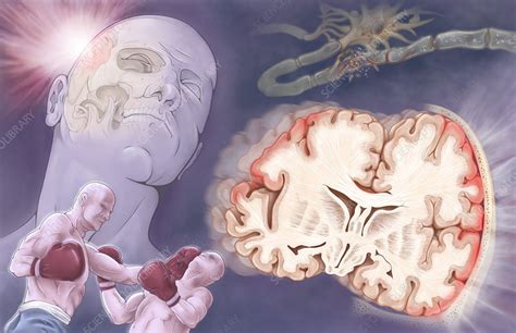 Traumatic Brain Injury Stock Image C0249762 Science Photo Library