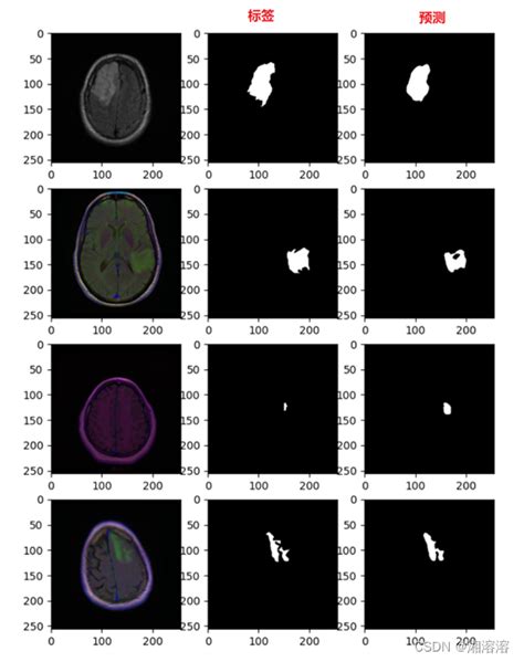 Unet脑肿瘤分割完整代码脑肿瘤分割代码 Csdn博客
