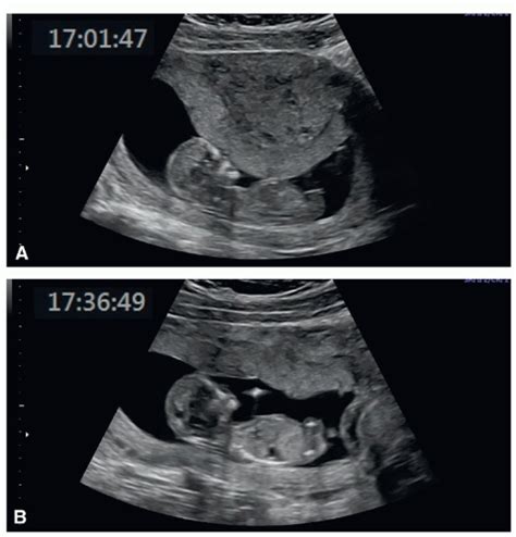 The Detailed First Trimester Ultrasound Examination Radiology Key