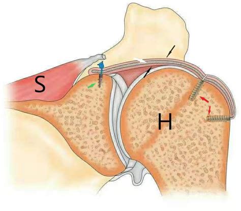 Arthroscopic Superior Capsule Reconstruction With Combined Fascia Lata