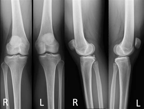 Preoperative Standing Anteroposterior And Lateral Plain Radiographs Of