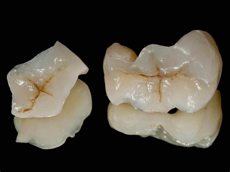 Restaurações Em Porcelana Odontomania