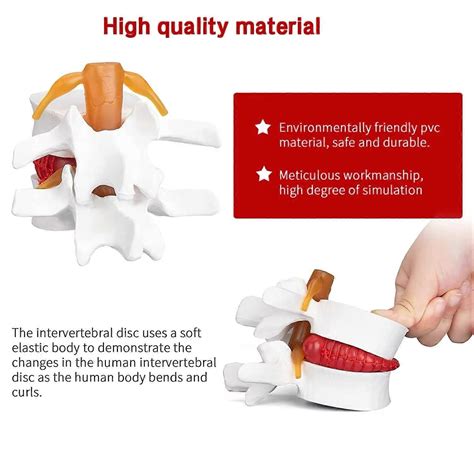 Human Anatomical Lumbar Disc Herniation Model - 1.5X Life Size Spine