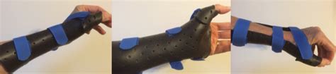 Splint in the Spotlight – The Long Opponens / Thumb Spica Orthosis - Orfit Industries