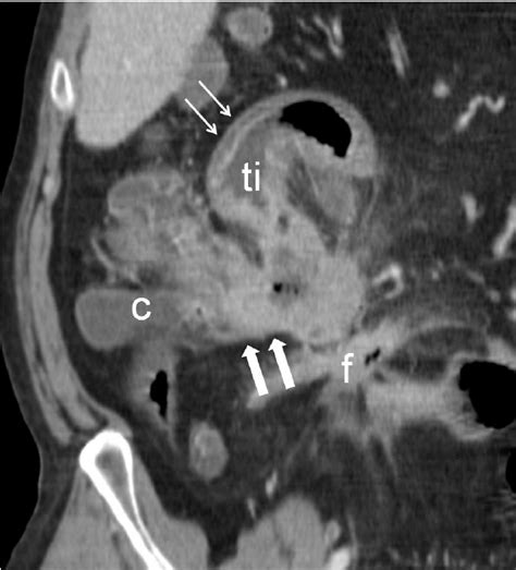 Neoplasm Of Ileocecal Valve The Risk Of Developing A Colorectal Cancer Download Scientific