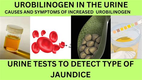 UROBILINOGEN IN THE URINE INCREASED CAUSES SYMPTOMS OF HIGH