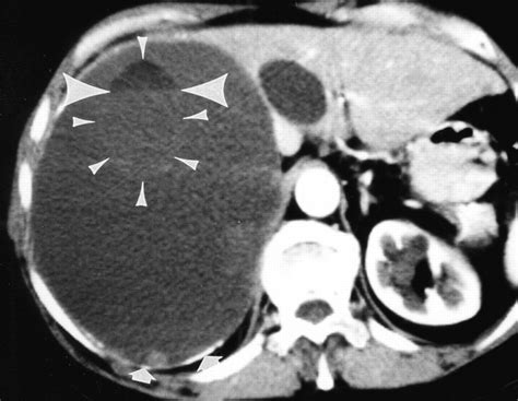 Echinococcus Multilocularis Liver