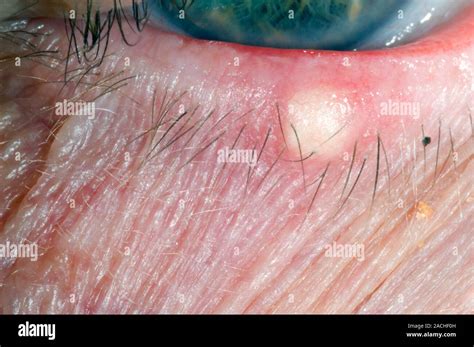 Close Up Of The Lower Eyelid In A 76 Year Old Male Patient Showing A