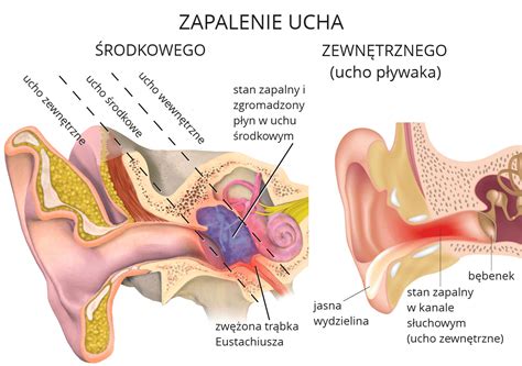 Zapalenie Ucha Objawy Higiena I Agodzenie B Lu Leczenie Profilaktyka