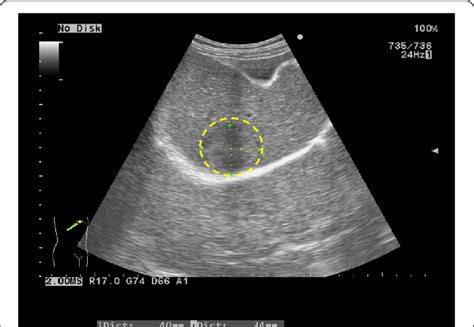 Abdominal Ultrasonography Us Abdominal Us Showed A Cm Solid Tumor