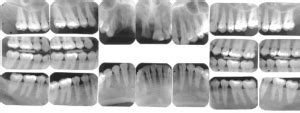 X Rays Radiographs Oceansight Dental Implants