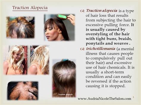 Traction Alopecia | Hair science, Hair loss specialist, Traction alopecia