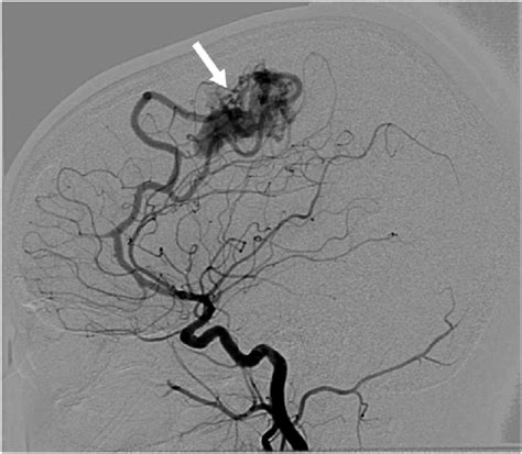 Digital Subtraction Cerebral Angiography Confirmed An Arteriovenous