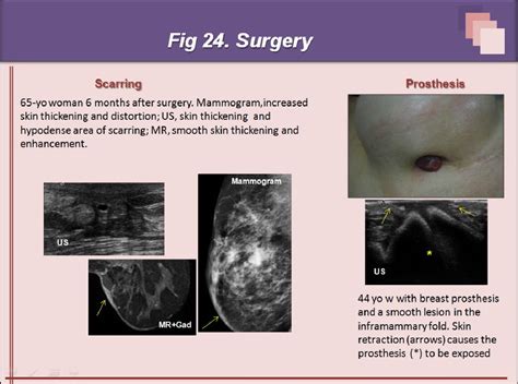 Superficial Breast Lesions A Comprehensive Review Of Skin And